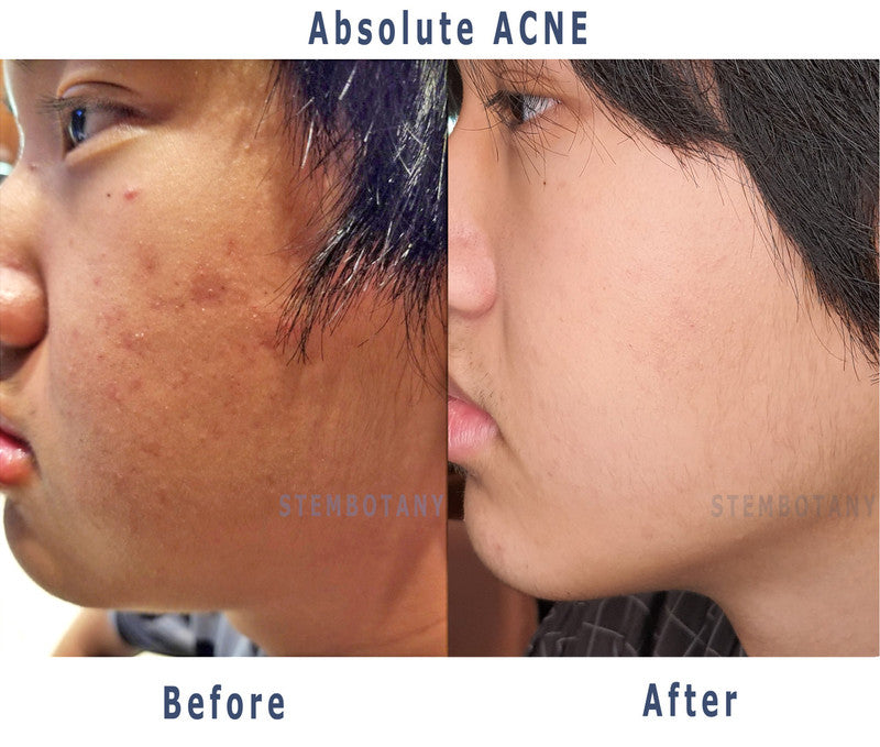 앱솔루트 줄기세포 여드름 트리트먼트 Stem Cell ACNE Special Treatment