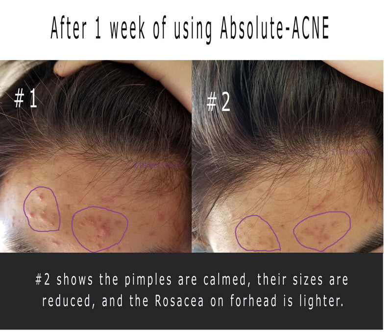 앱솔루트 줄기세포 여드름 트리트먼트 Stem Cell ACNE Special Treatment
